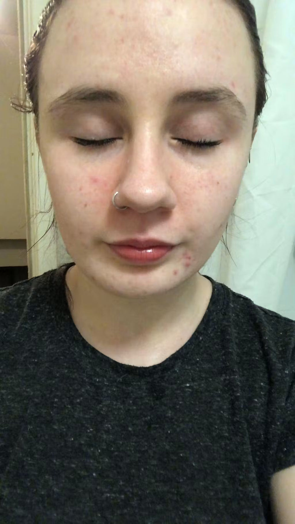 acne BG keep